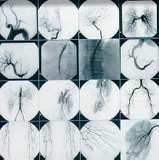 voorbeeld van angiografie