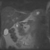 MRI abdomen 5